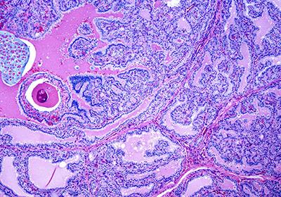 Frontiers The Pathology Of Hyperthyroidism